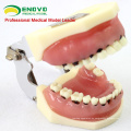 VENDER 12610 Modelo de mandíbula grave para entrenamiento de cirugía periodontal